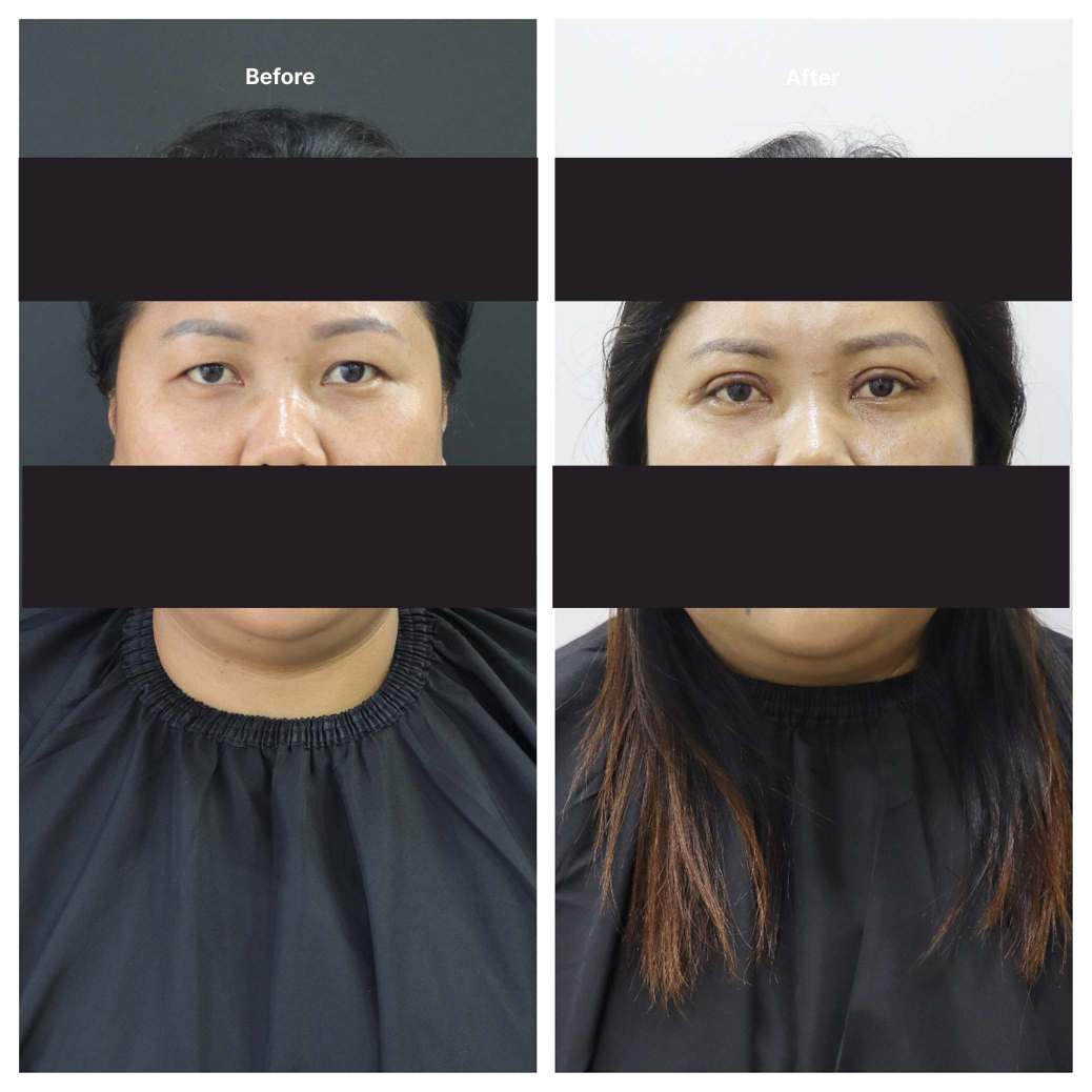 Eyelid Surgery KOQ10